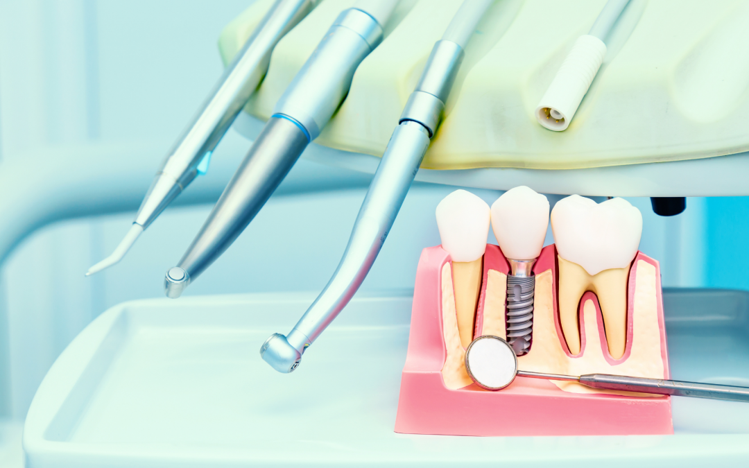 Impianti dentali: come sostituire i denti mancanti