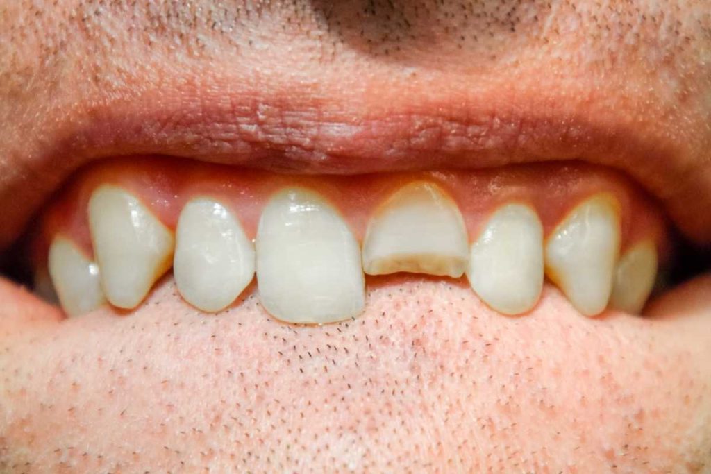 denti-incisivi
