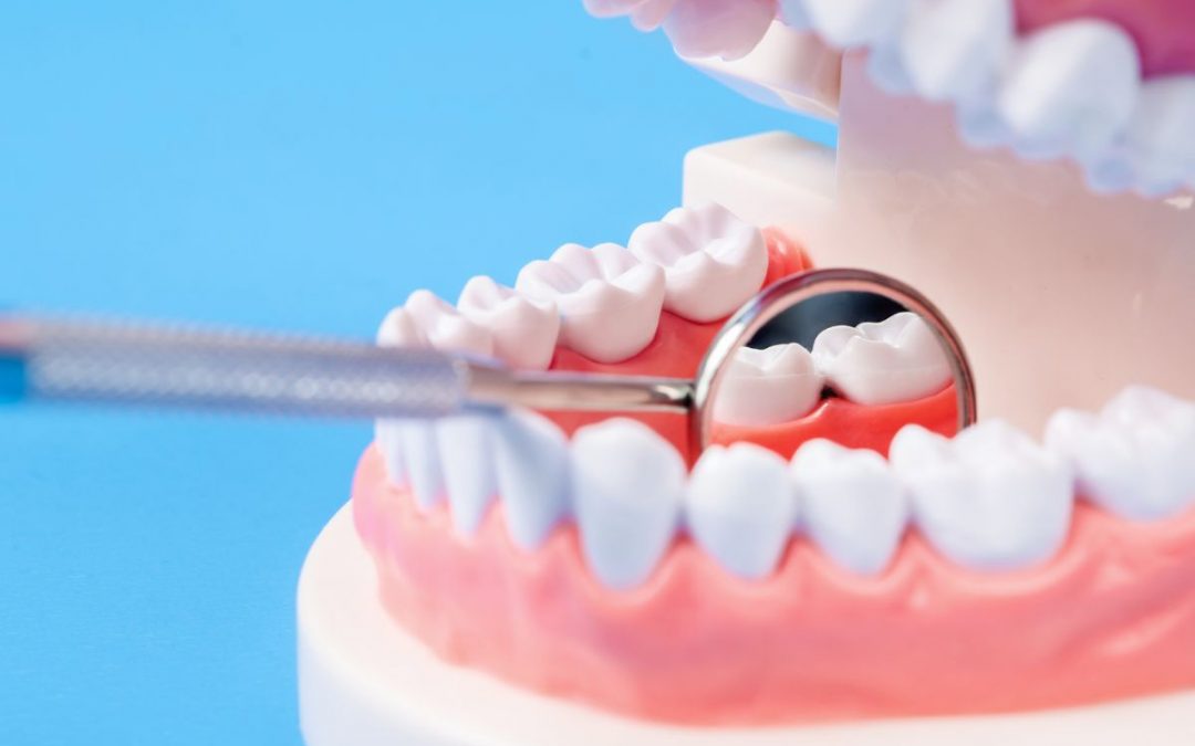 Bite dentale, cos’è e quali vantaggi offre