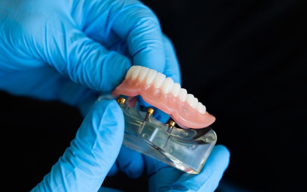 Protesi dentarie: fissa, mobile o removibile. Come scegliere?